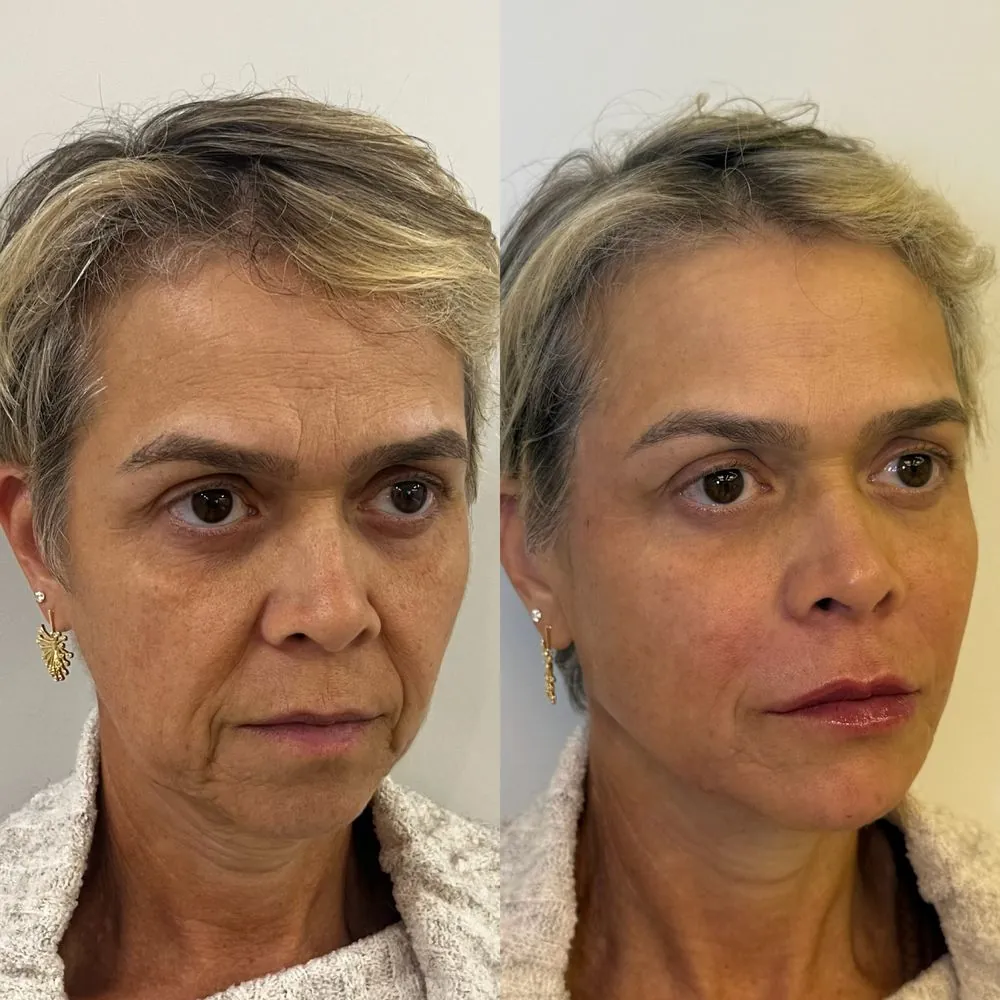 Resultado de tratamento Full Face — paciente 1 — antes e depois