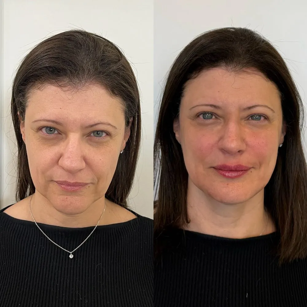Resultado de tratamento Full Face — paciente 2 — antes e depois