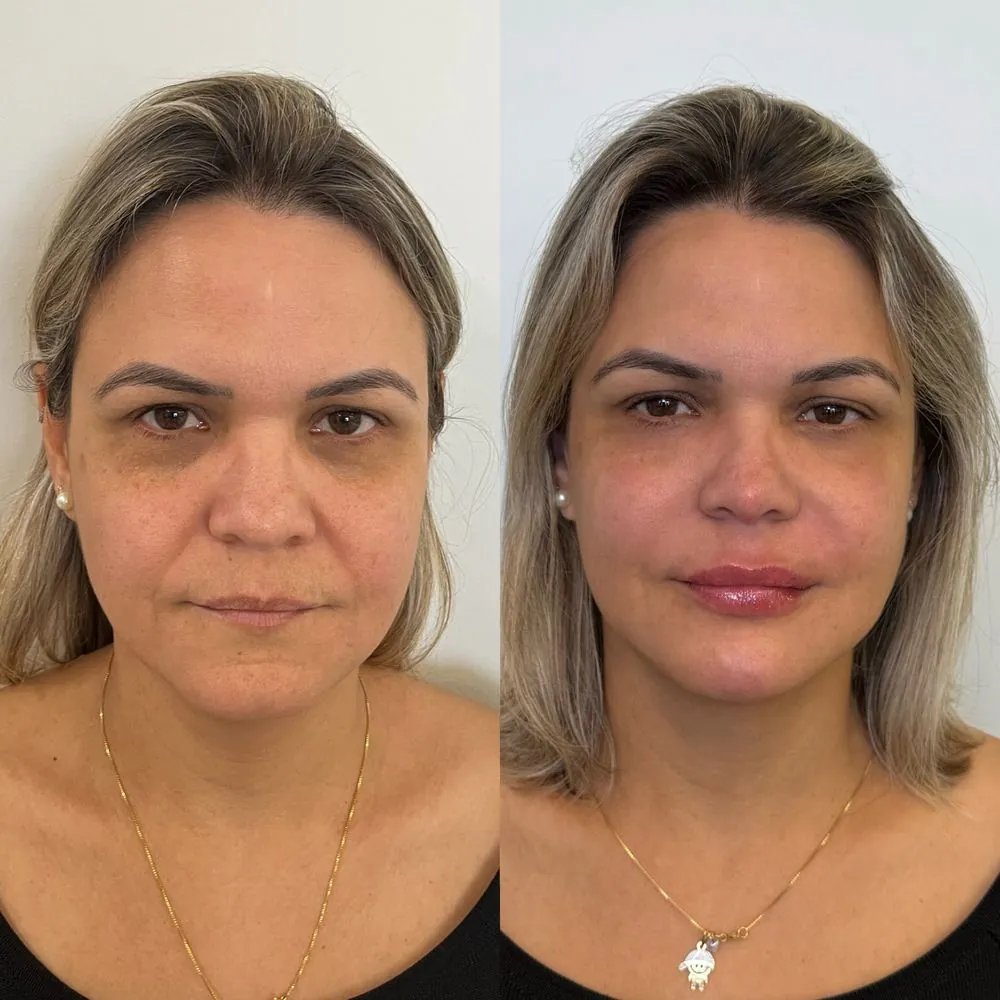 Resultado de tratamento Full Face — paciente 3 — antes e depois